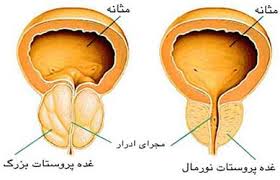 مراقبتهای بعد از جراحی برداشتن پروستات به روش TURP