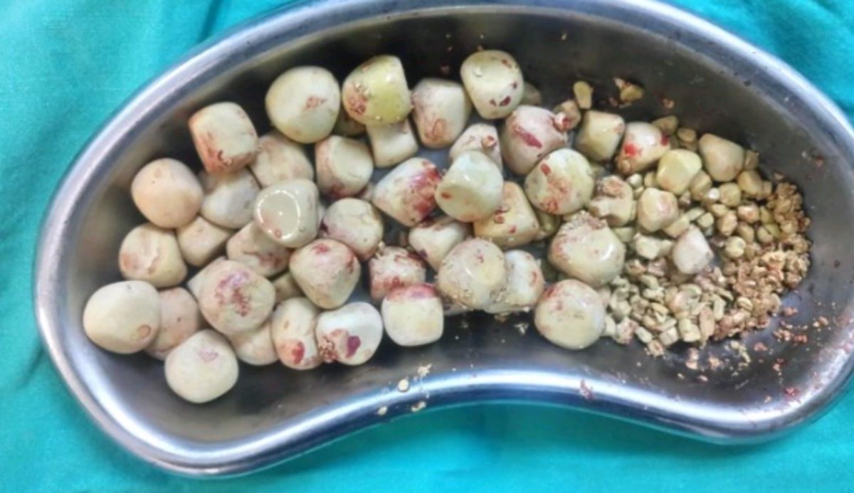 سنگهای متعدد مثانه در یک بیمار ۶۴ ساله ناشی از بزرگی خوش خیم پروستات طی عمل جراحی توسط دکتر کرمی خارج شد