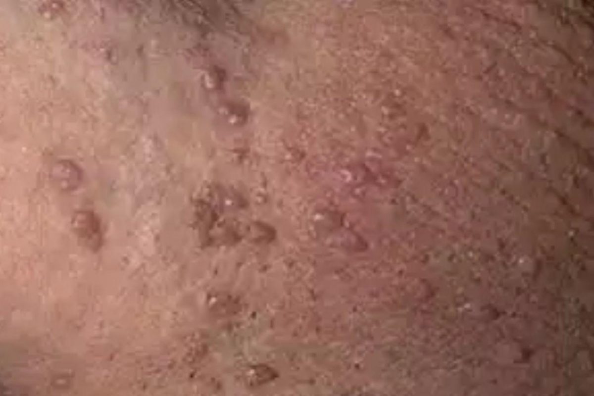 زگیل تناسلی – علائم و دلایل ابتلا به زگیل تناسلی