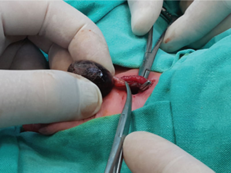جراحی پیچش بیضه