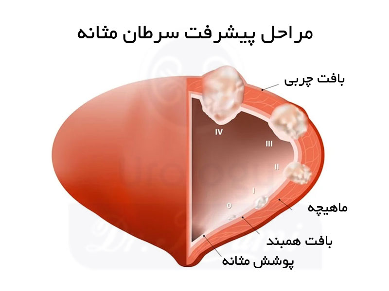 مراحل پیشرفت سرطان مثانه