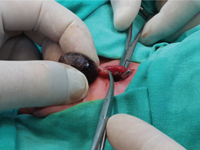 Cirurgia de torção testicular