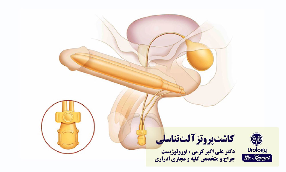 کاشت پروتز آلت تناسلی درمان ناتوانی جنسی