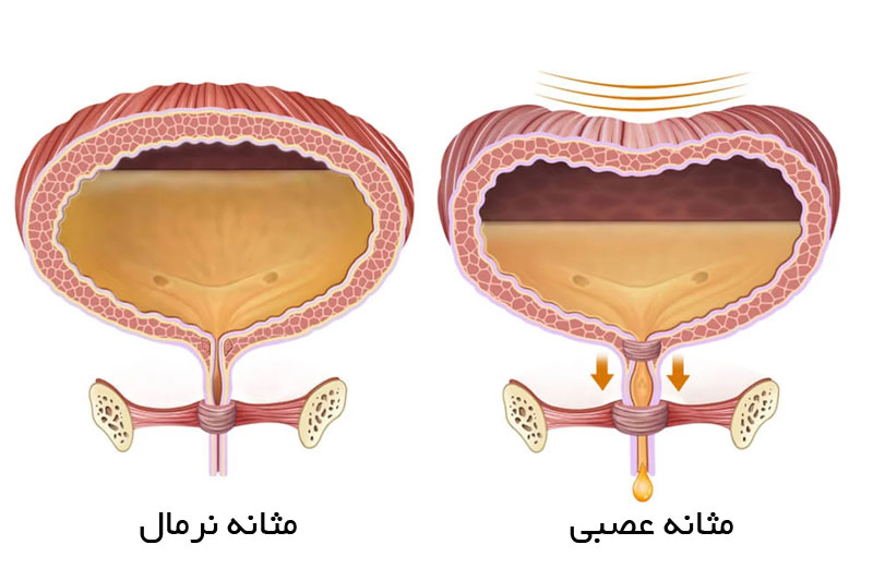 مثانه عصبی