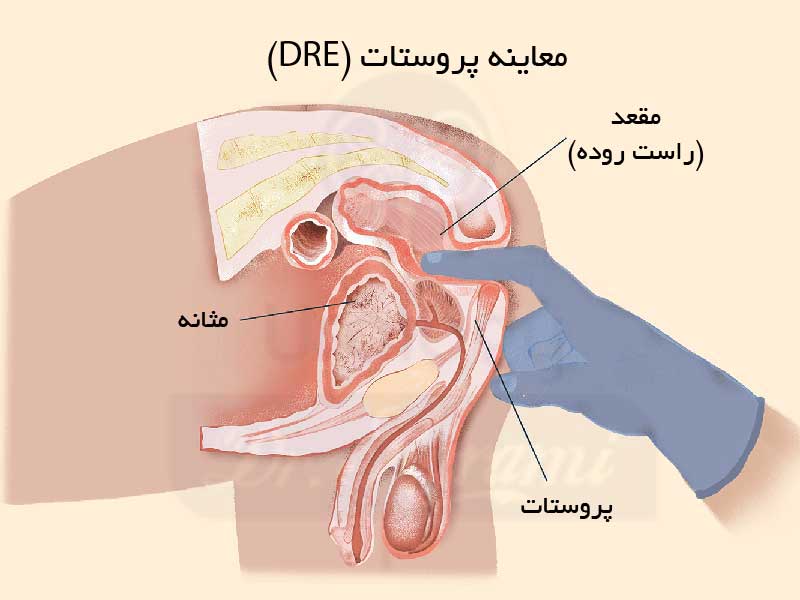 معاینه پروستات چیست؟
