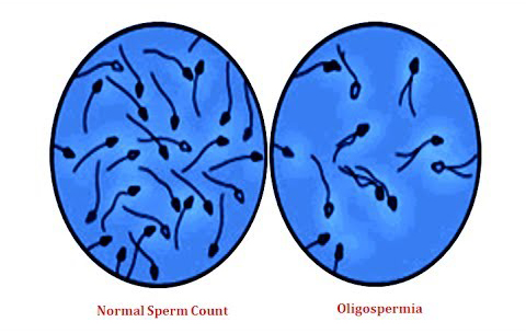 urologykarami-sperm-oligos.jpg