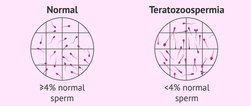 Teratozoospermia
