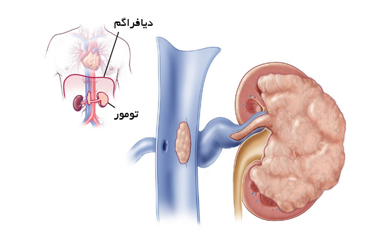 علائم سرطان کلیه