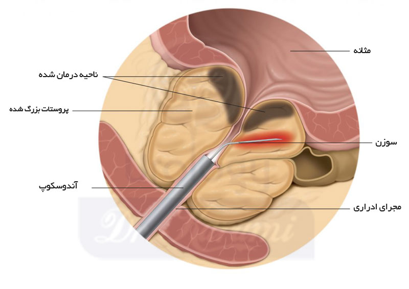 جراحی پروستات بزرگ شده