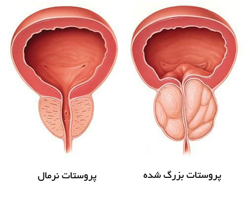 بزرگی خوش خیم پروستات