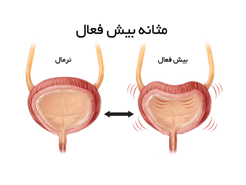 مثانه-بیش-فعال