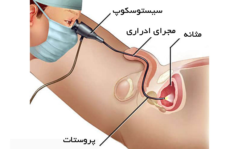 نحوه انجام سیستوسکوپی