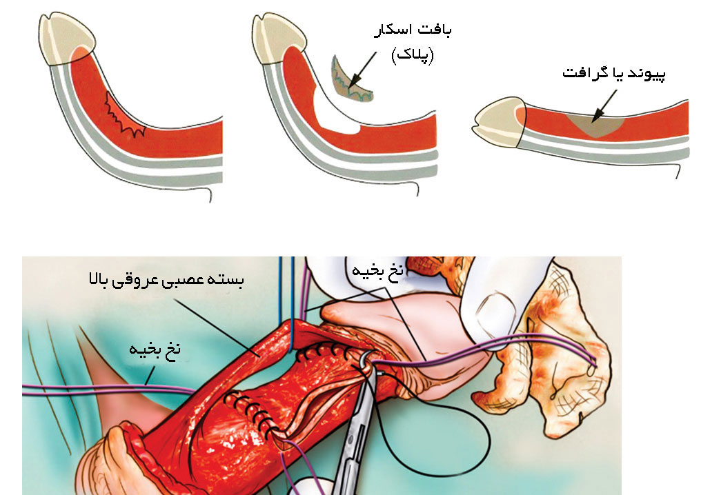 جراحی برای بیماری پیرونی