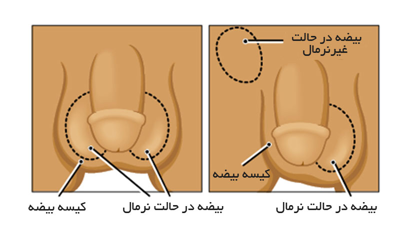 شماتیک بیضه نزول نکرده