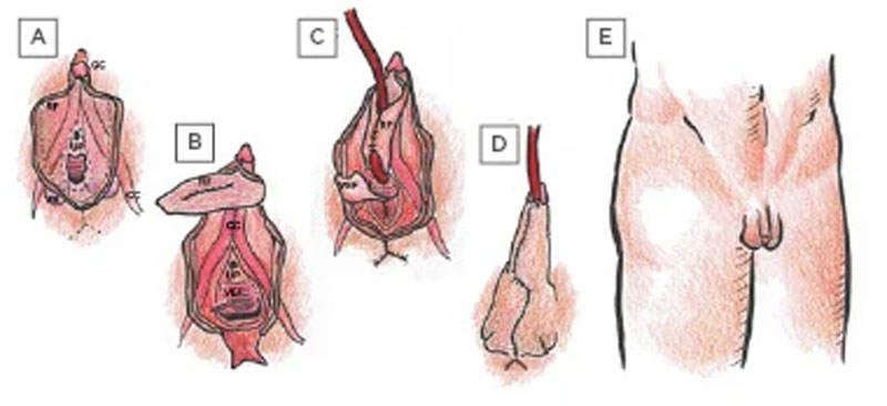 متویدیوپلاستی