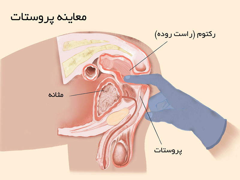 معاینه پروستات