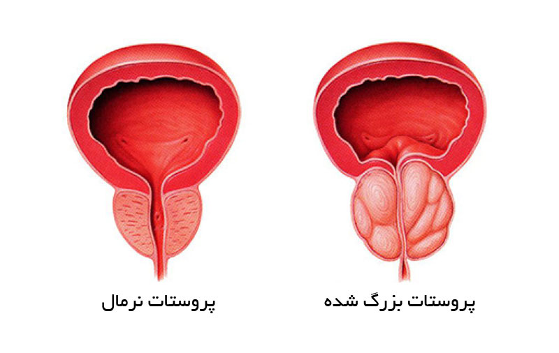 پروستات بزرگشده