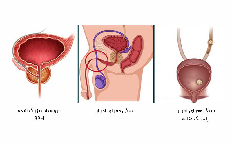 دلایل احتباس ادرار