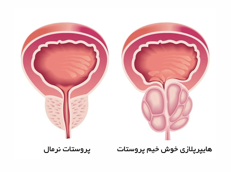هایپرپلازی خوش خیم پروستات