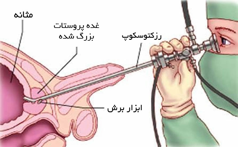 عمل جراحی TURP