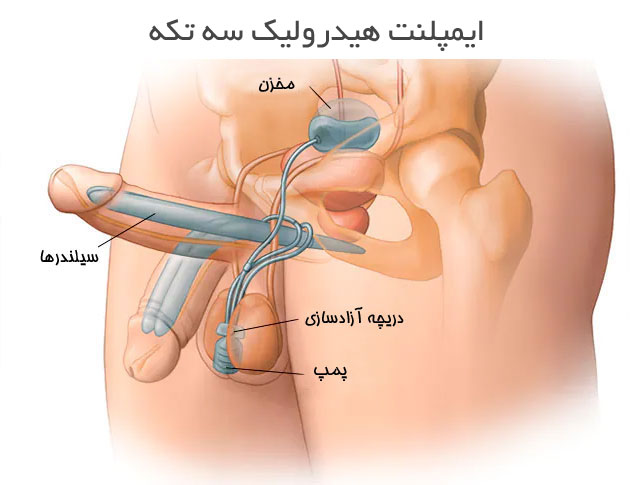 ایمپلنت هیدرولیک سه تکه