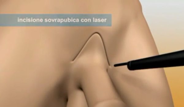 انیمیشن عمل جراحی افزایش طول و قطر آلت تناسلی