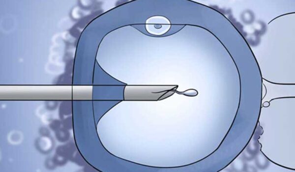 تزریق داخل سیتوپلاسمی اسپرم