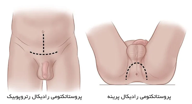 انواع پروستاتکتومی رادیکال جراحی باز