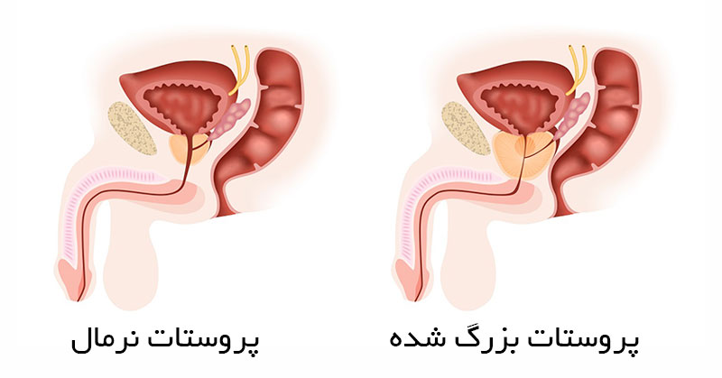 جراحی پروستات