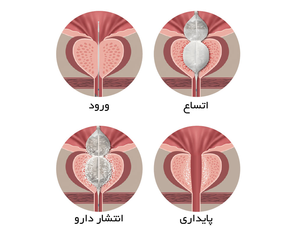 درمان بزگی خوش خیم پروستات