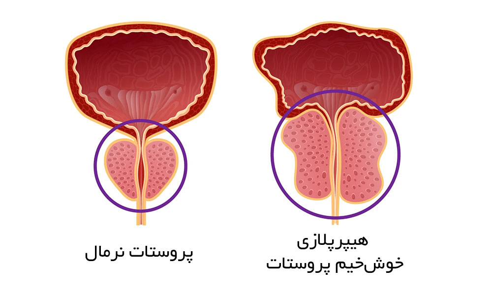 هیپرپلازی خوشخیم پروستات