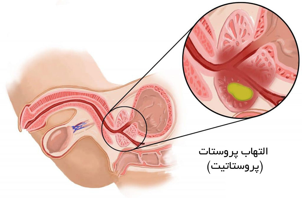 التهاب پروستات پروستاتیت