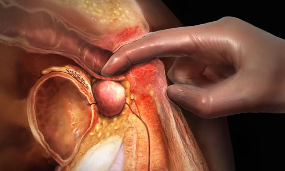 معاینه فیزیکی پروستات